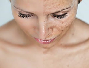 Pigmentation Treatment Bournemouth