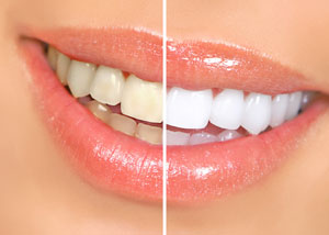 Laser Teeth Whitening Bournemouth